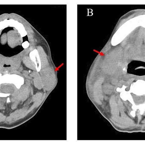 Plain Computed Tomography Scan Of The Neck On Day Six Post Chimeric