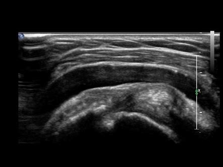 Subacromial Subdeltoid Bursa Injection Ultrasound Guided Image