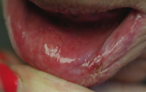 Red Rash Inside Lips