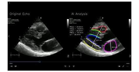 RSIP Vision Announces New Cardiac Diagnostic Tool For Point Of Care