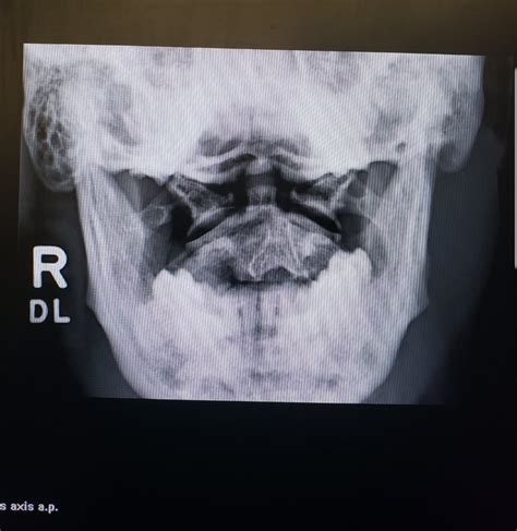 Odontoid to start my shift : r/Radiology