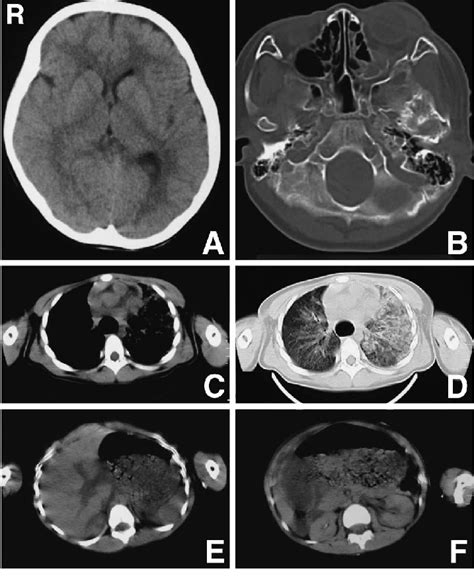 Computed Tomography Scans Of The Head A B Chest C D And Abdomen