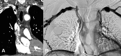 A Preoperative Ct Angiography Showing Svc Occlusion B Preoperative