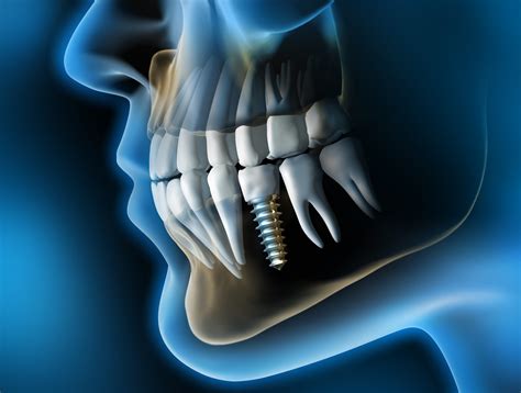 What If You’ve Lost Too Much Bone For Dental Implants Treatment?