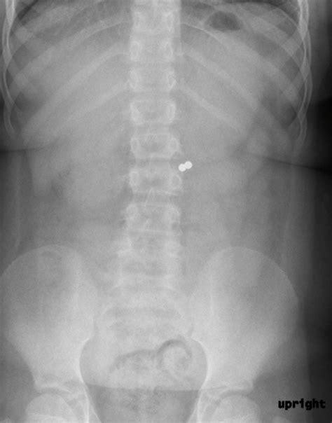 Foreign Body Ingestion/Aspiration – Undergraduate Diagnostic Imaging ...