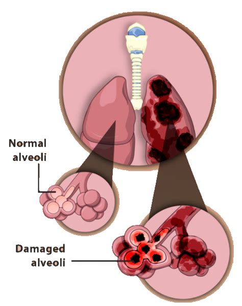 Describe Disorders Of The Respiratory System