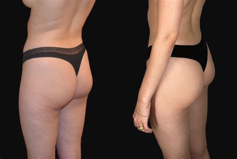 Butt Implants Beverly Hills Los Angeles Buttock Implants