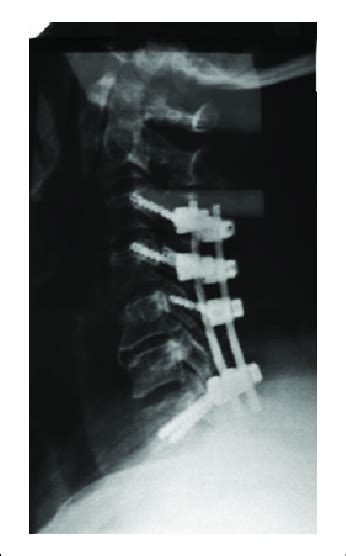 Lateral View Of Cervical Spine Showed Lateral Mass Screws Of C And