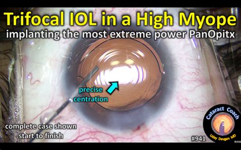 PanOptix IOL in a Highly Myopic Patient – Cataract Coach™