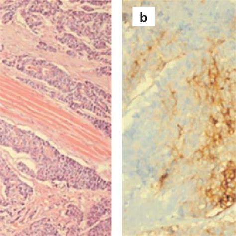 The Tumor Cells With Hyperchromatic Nucleus And Eosinophilic Cytoplasm