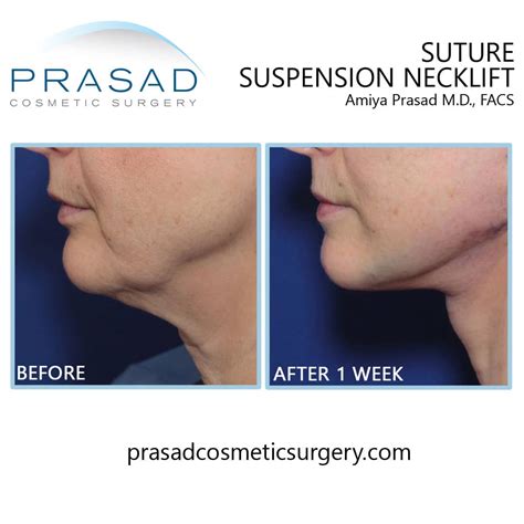 How to Choose the Best Neck Lift Procedure | Dr. Prasad Blog