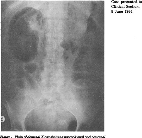 Figure 1 from Conjunctival Xerosis in Cystic Fibrosis | Semantic Scholar