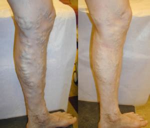 Sclerotherapy Varicose Vein Treatments In Pittsburgh