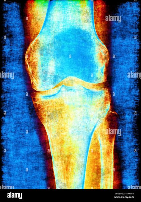 Normal knee x ray hi-res stock photography and images - Alamy