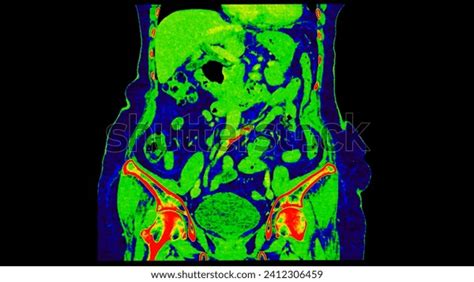 Ct Scan Abdomen Coronal View Injection Stock Illustration 2412306459