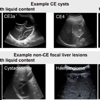 Example Ultrasound Images Of Focal Liver Lesions In Differential