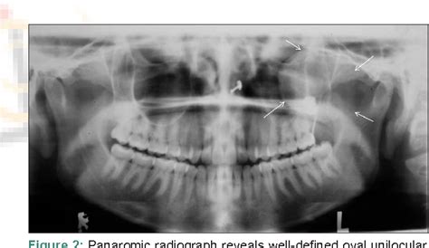 Figure 2 From Maxillary Keratocystic Odontogenic Tumor With