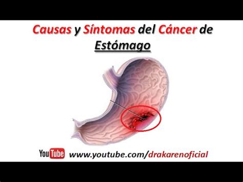 Que Sintomas Tiene El Cancer De Estomago - CancerWalls