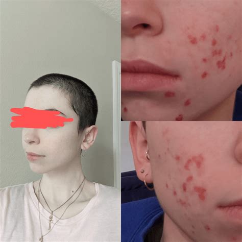 Acne And Accutane Induced Staph Infection Update With Pictures Pic On