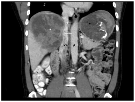 Modified Hanging Manoeuvre Facilitates Inferior Vena Cava Resection And