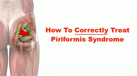 Piriformis Syndrome Pain Pattern