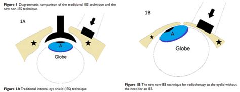 Radiotherapy For Eyelid Cancer Xstrahl