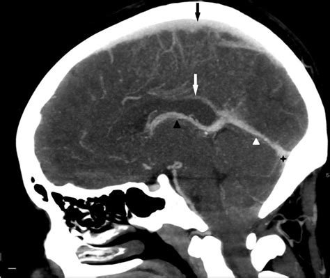 Imaging Of Cerebral Venous Thrombosis Clinical Radiology