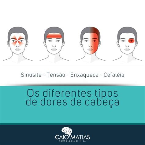 Dr Caio Matias On Instagram “existem Diferentes Tipos De Dor De Cabeça Que Podem Ocorrer Por