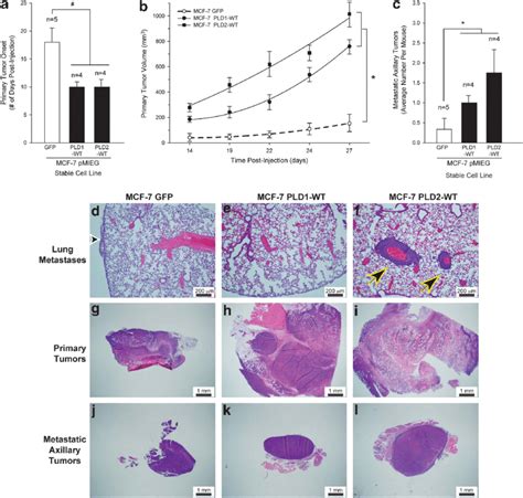 Pld Overexpression Of Scid Mouse Metastastic Breast Cancer Model