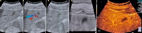 A Case Of Inflammatory Pseudotumor A Hypoechoic Lesion With Irregular