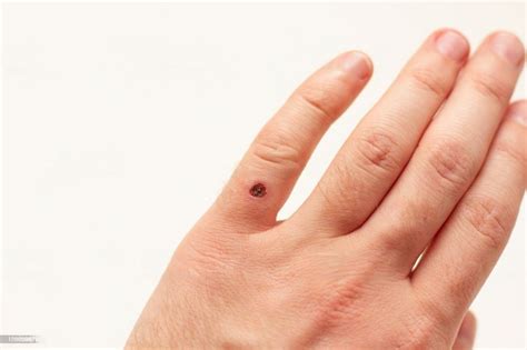 Wart Removal Treatment In Bangalore Cost Procedure Vitalsklinic