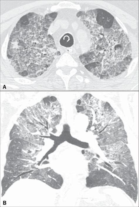 Scielo Brasil High Resolution Computed Tomography Findings In Eight