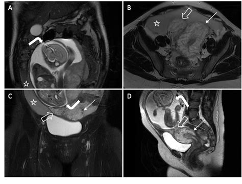 PDF Uterine Rupture Of A Patient With Rudimentary Horn Pregnancy At