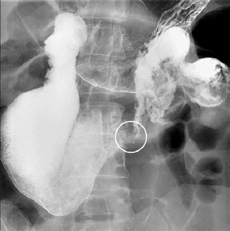 upper gi demonstrating duodenal dilation  decompressed small bowel