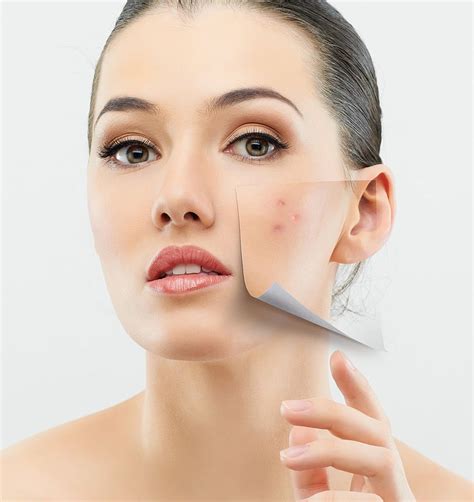 How To Treat Hormonal Acne Boston And Wellesley Hills