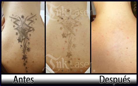 Eliminar Tatuajes Valencia Al Mejor Precio Y Quitar Tattoos Ink L Ser