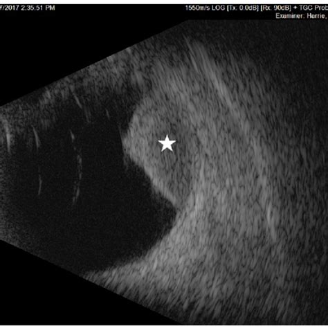 Arterial Enhancement Of Choroidal Melanoma On Mri Scan Enabling Imaging