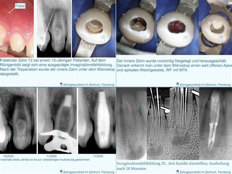 Zahngesundheit Im Zentrum Berweisungen Endo