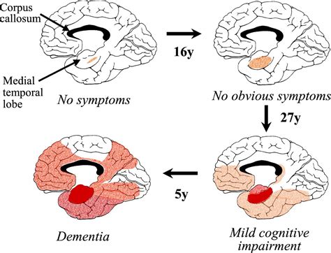 Imaging The Progression Of Alzheimer Pathology Through The Brain PNAS