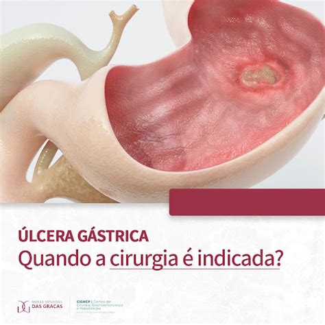 Lcera G Strica Quando A Cirurgia Indicada Cighep