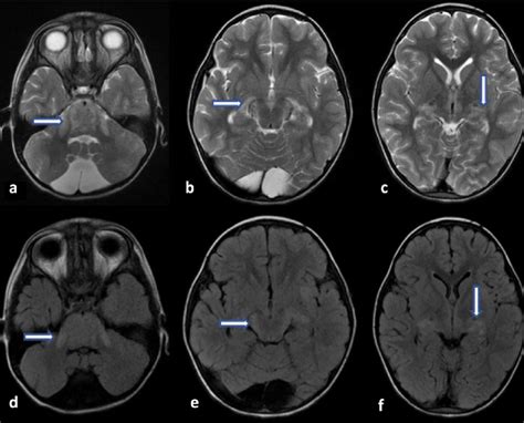 MRI findings in the 1st attack of patient 5. There is extensive ...