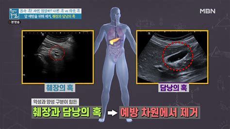 몸속 혹 과연 암일까 발견 즉시 제거해야 하는 나쁜 혹은 네이버 포스트