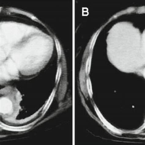 Preoperative Computed Tomography CT Scans Show A Nonaneurysmal Aortic