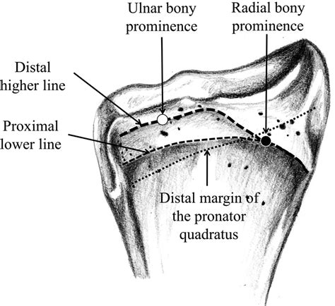 Volar Distal Radius Anatomy Applied To The Treatment Of Distal Radius