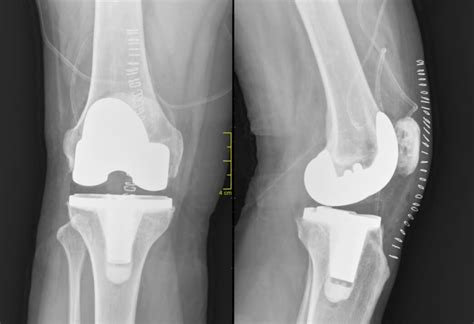 What Are The Causes Of Stiffness After Total Knee Replacement Artofit