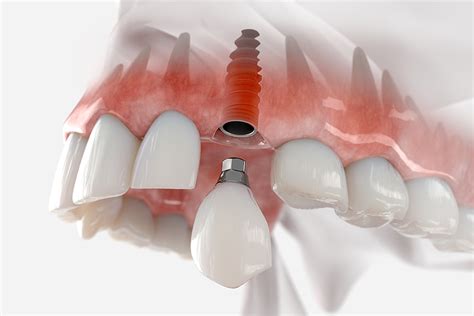 Advanced Implant Centers Louisville Ky