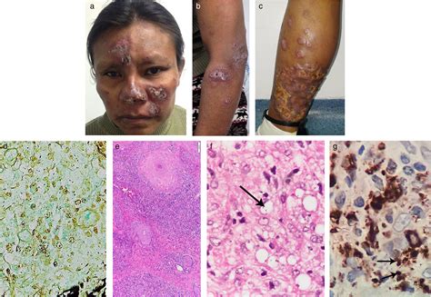 Disseminated Cutaneous Lesions in an Immunocompromised Patient: A