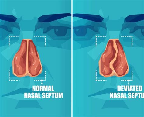 Septoplasty And Turbinate Reduction Sinushealth