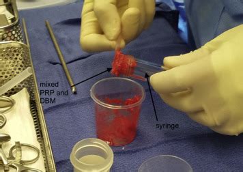 Intraosseous Bioplasty For A Chondral Cyst In The Lateral Tibial