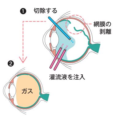 網膜剥離 病気ガイド 医療法人社団済安堂 井上眼科病院グループ